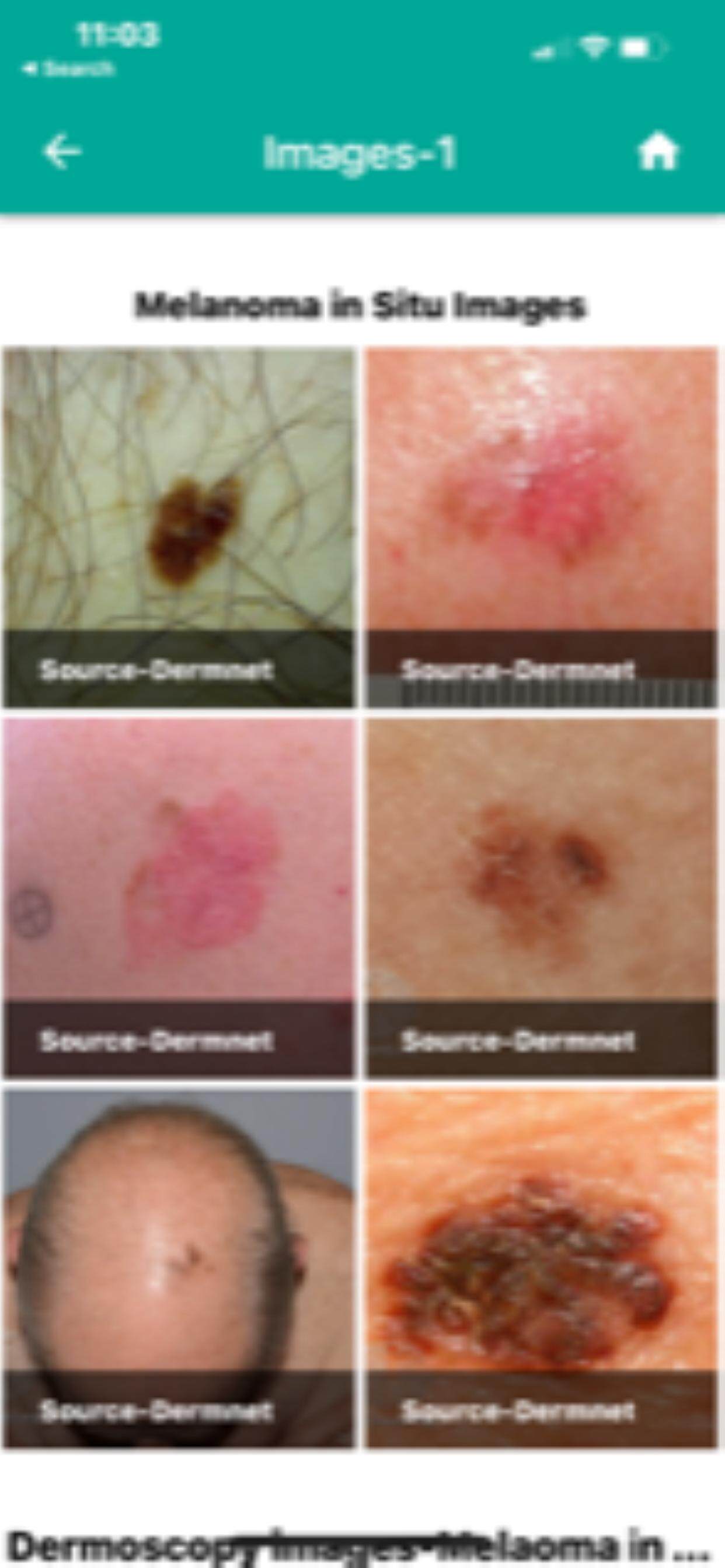 Skin cancer Scoring  App